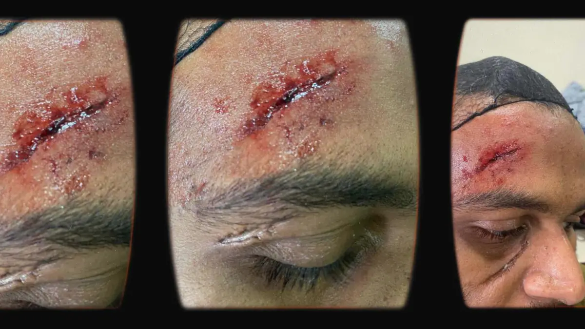 Prosthetic Work portfolio page 7