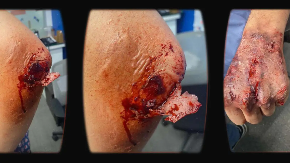 Prosthetic Work portfolio page 11