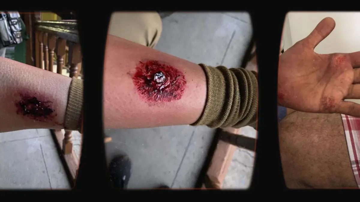 Prosthetic Work portfolio page 13