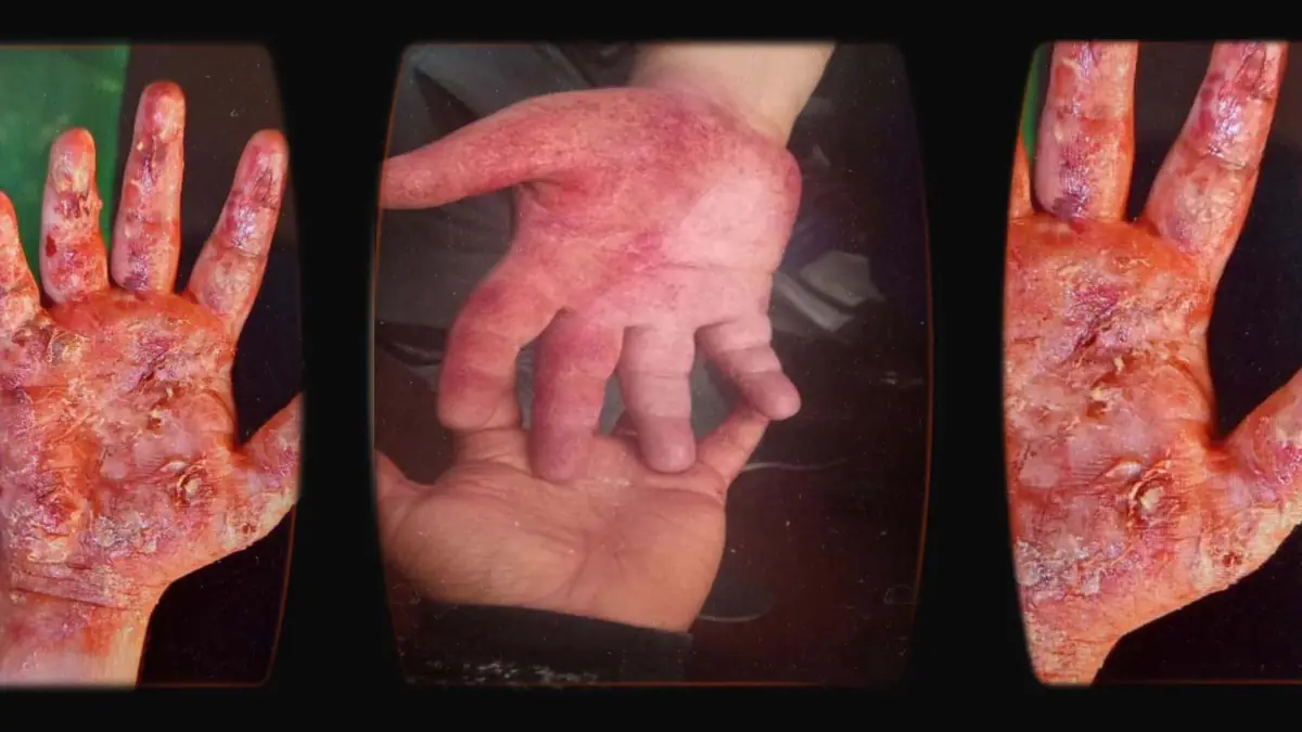 Prosthetic Work portfolio page 18