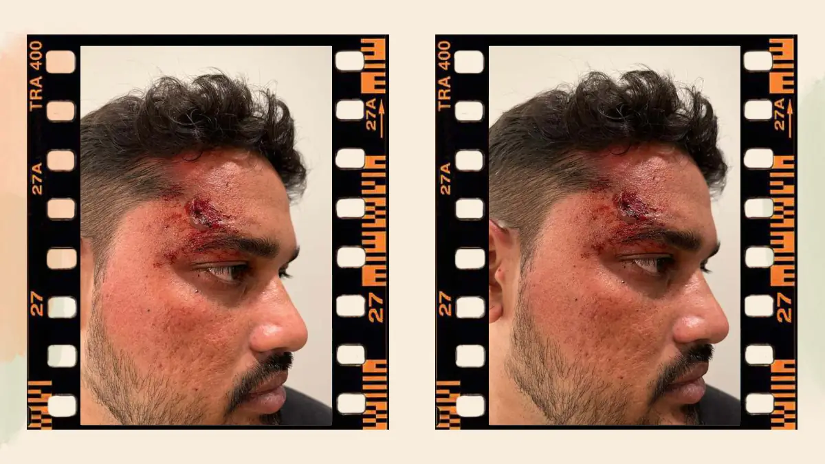 Prosthetic Work portfolio page 53